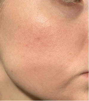 After consistent use of PrimeTallow Skin Care Cream